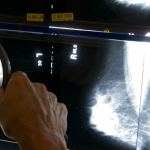 Artificial Intelligence Reads Mammograms With 99% Accuracy